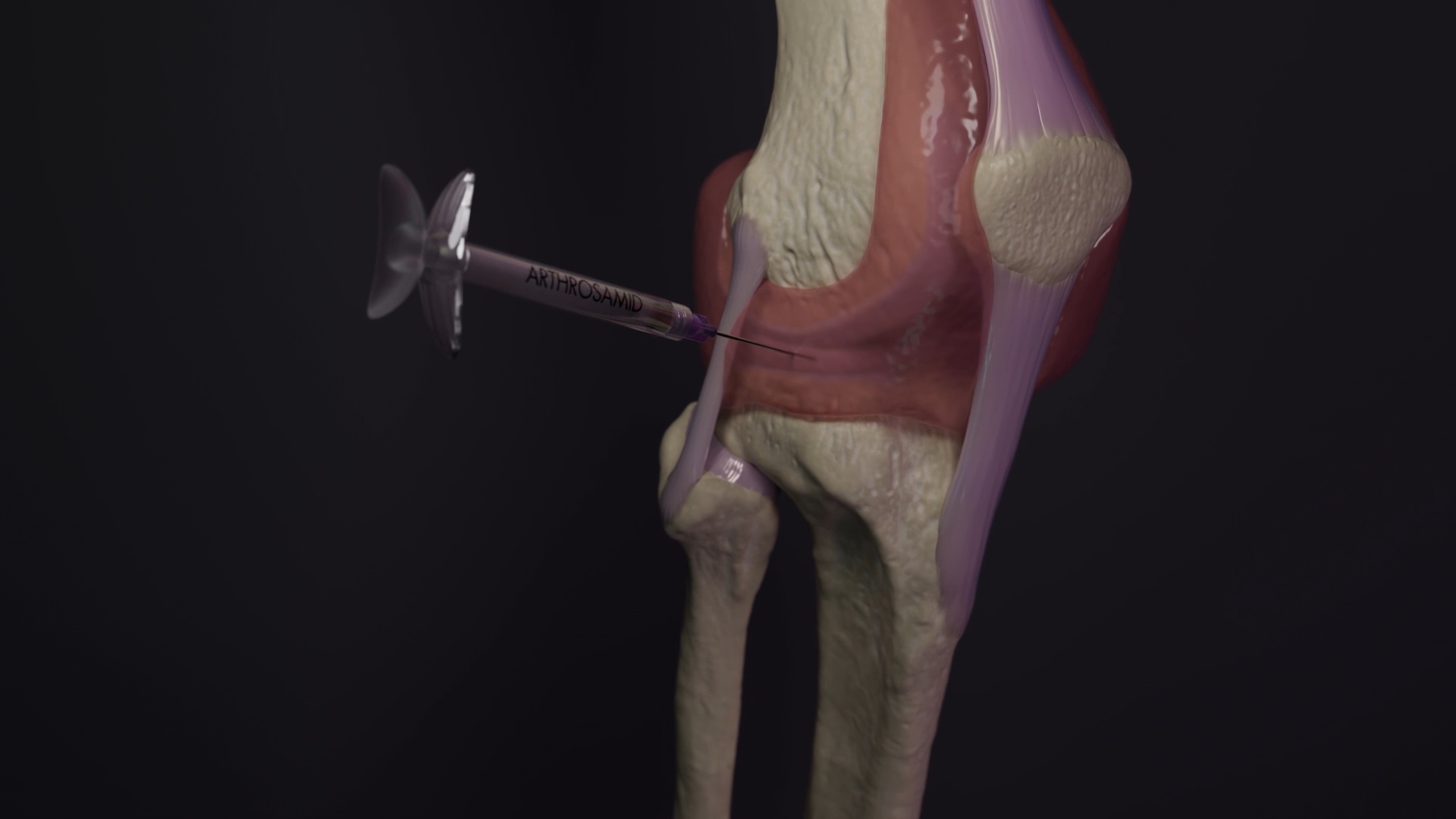 arthrosamid.
